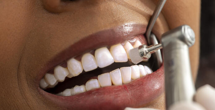 Teeth being polished