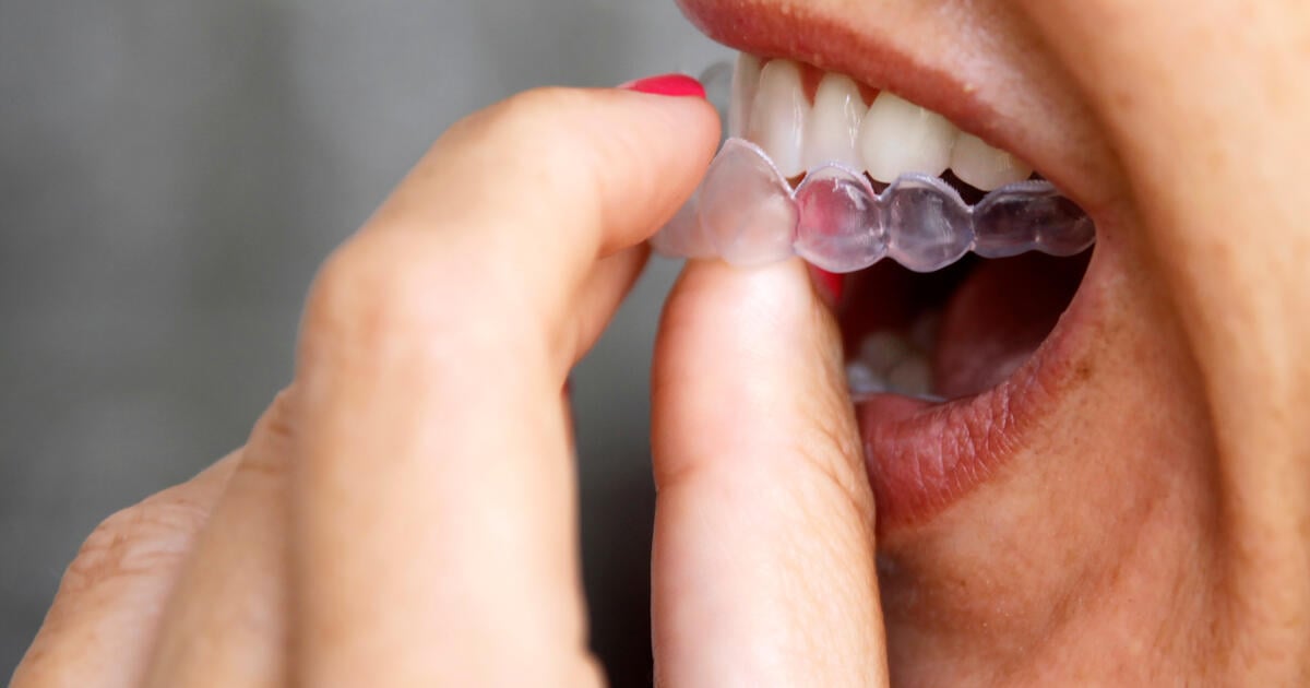 Close-up Of Young Woman Wearing Clear Invisible Orthodontics - SEOSocialEditorial image