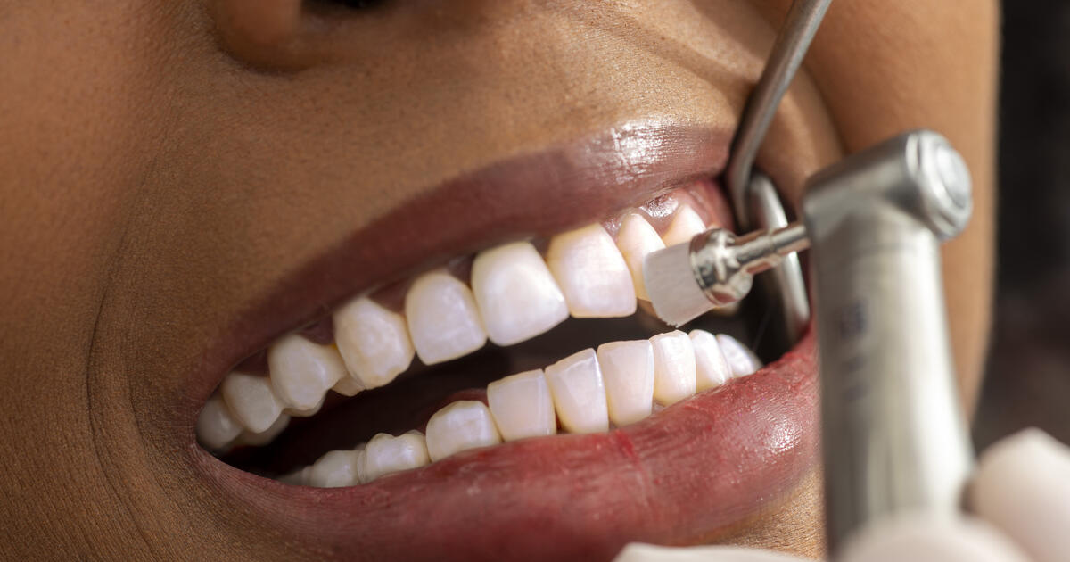 Teeth being polished